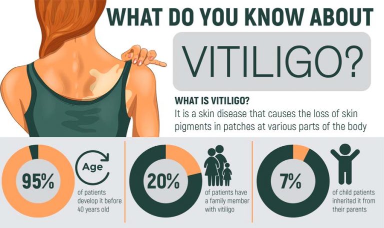 Vitiligo treatment steps - Dr. Mukto Blog